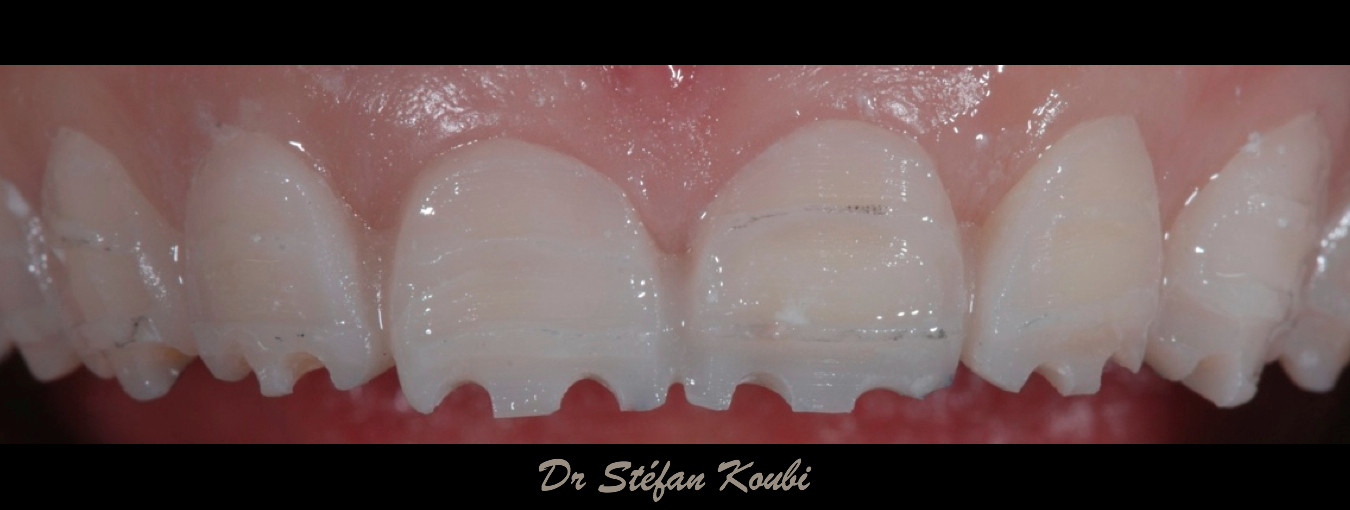 veneers and crowns /Dr Stefan Koubi